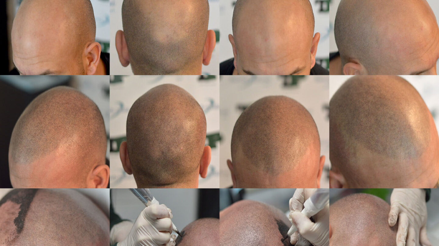 La técnica de Tricopigmentacion llevada a cabo en Medical Hair. 
