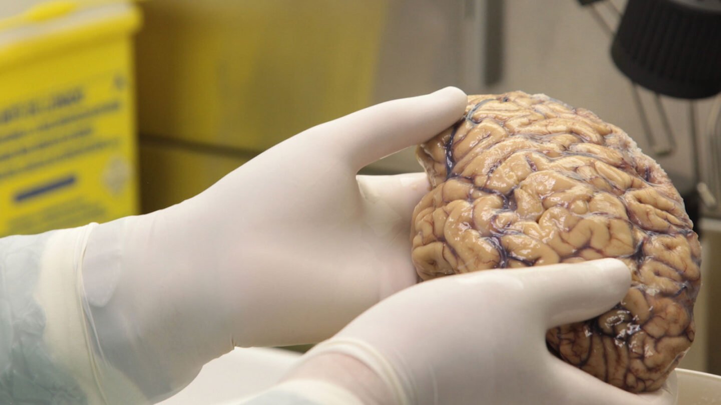 Hinchazón cerebral después de un trauma