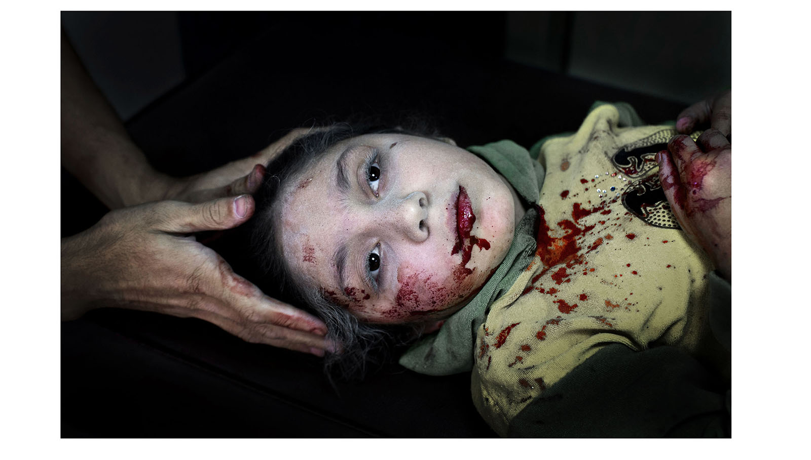 Dania Kilsi, de 11 años, es tratada por heridas de metralla en el hospital de Dar-al Shifa. Ella y sus dos hermanos menores estaban jugando fuera de su casa cuando resultaron alcanzados por una bomba. Son algunas de las miles de víctimas del conflicto en Siria, que comenzó en 2011 y sigue activo en la actualidad.