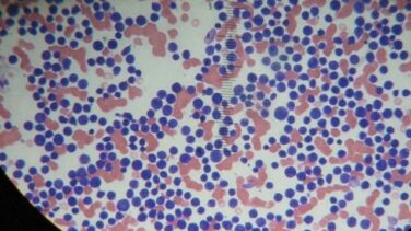 La Fundación Carreras revela la efectividad de un nuevo tratamiento contra la leucemia