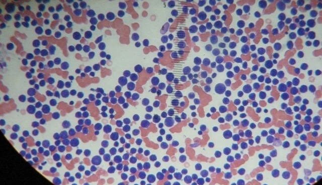 leucemia Leucemia