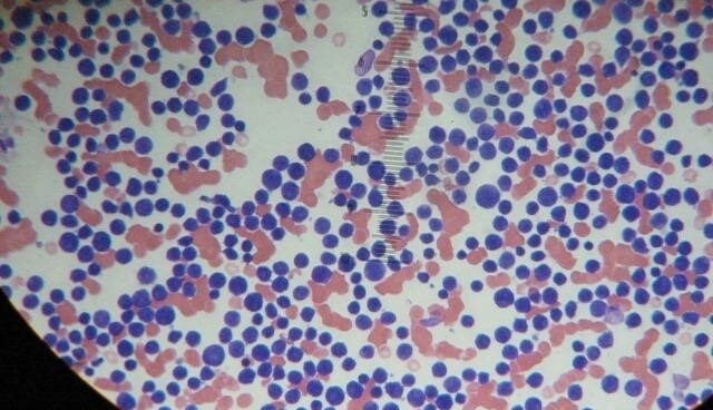 Leucemia