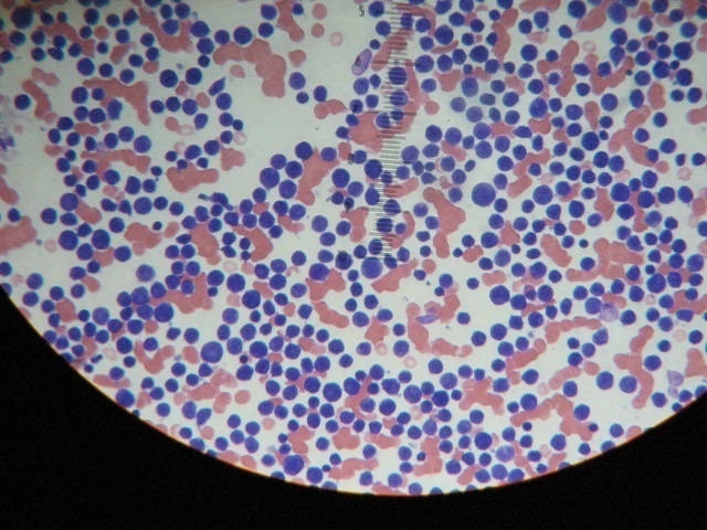 Leucemia