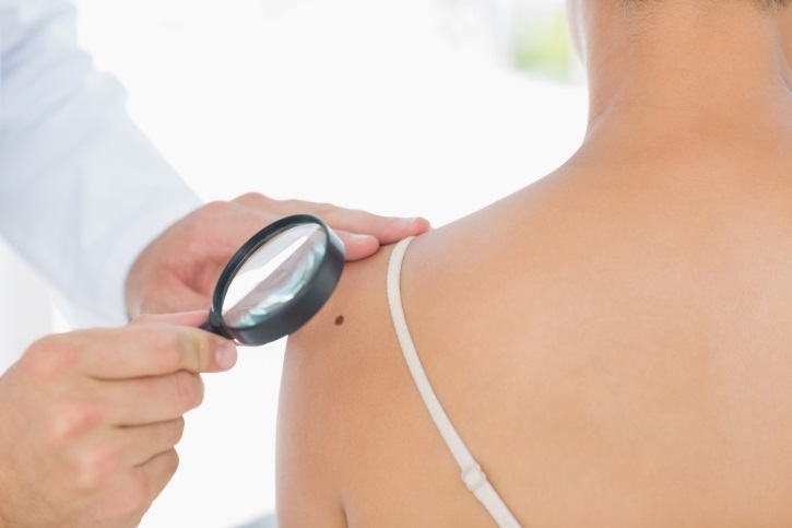 Cuídate del melanoma