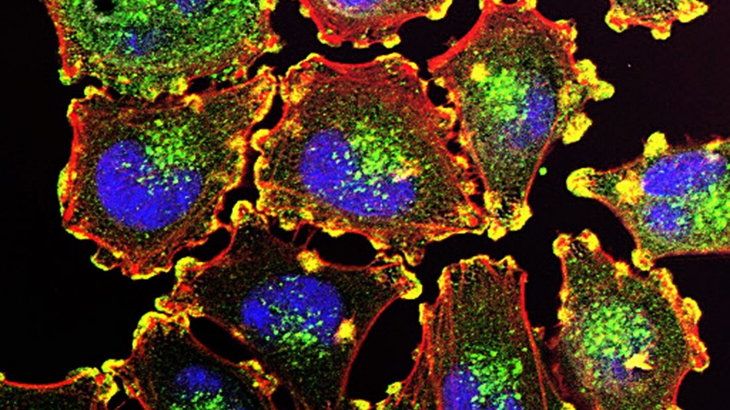 Células metastásicas de melanoma