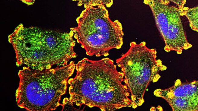 Células metastásicas de melanoma