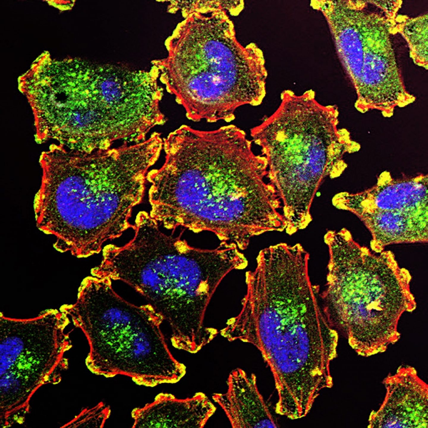 Células metastásicas de melanoma
