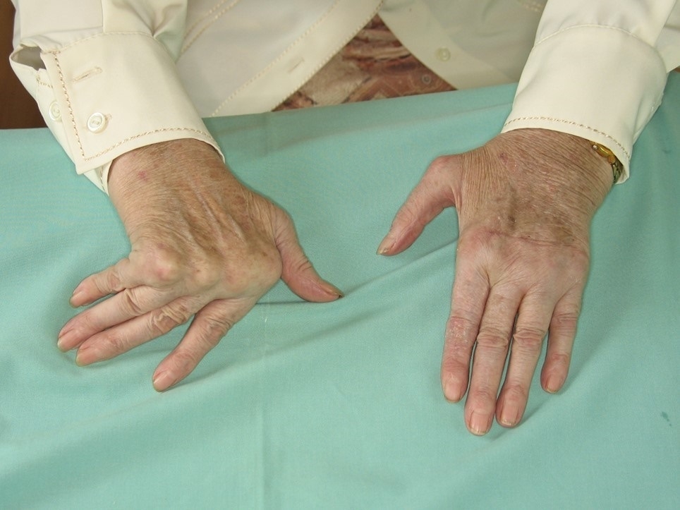 Inflamación en artritis reumatoide.