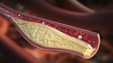 El colesterol 'malo', principal factor de riesgo para que alguien sano sufra un infarto o ictus