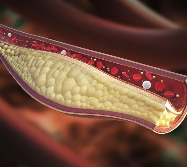 El colesterol 'malo', principal factor de riesgo para que alguien sano sufra un infarto o ictus