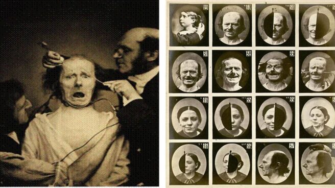 Los pacientes frankenstinianos de Duchenne Los pacientes frankenstinianos de Duchenne