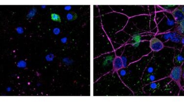 Descubren un proceso contra la muerte neuronal que causan el Alzheimer o los ictus