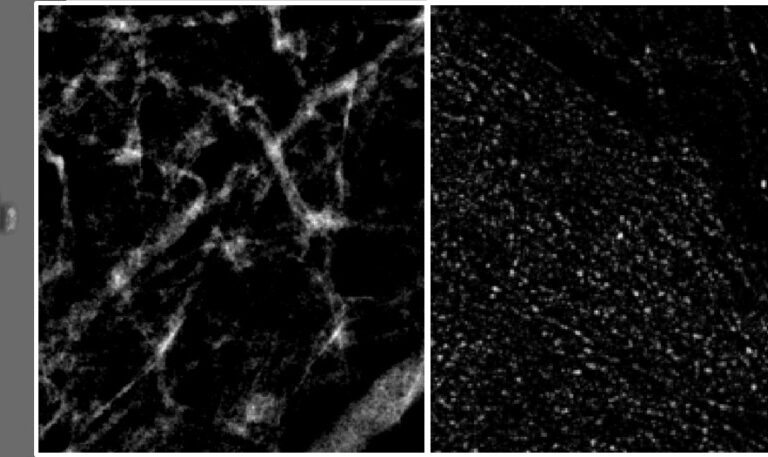 Inteligencia artificial para reducir falsos positivos en cáncer de mama