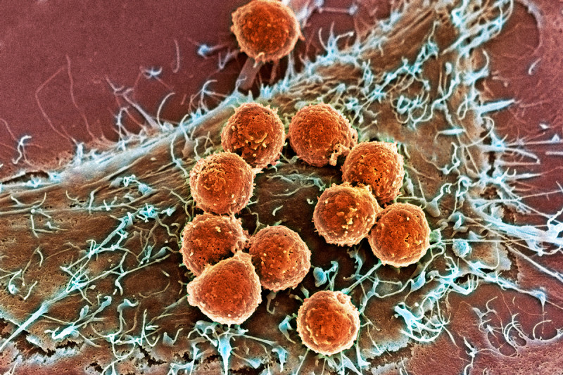 Células T (naranjas) atacando un tumor