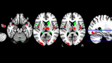 El cerebro de quien desarrollará alzhéimer es genéticamente distinto