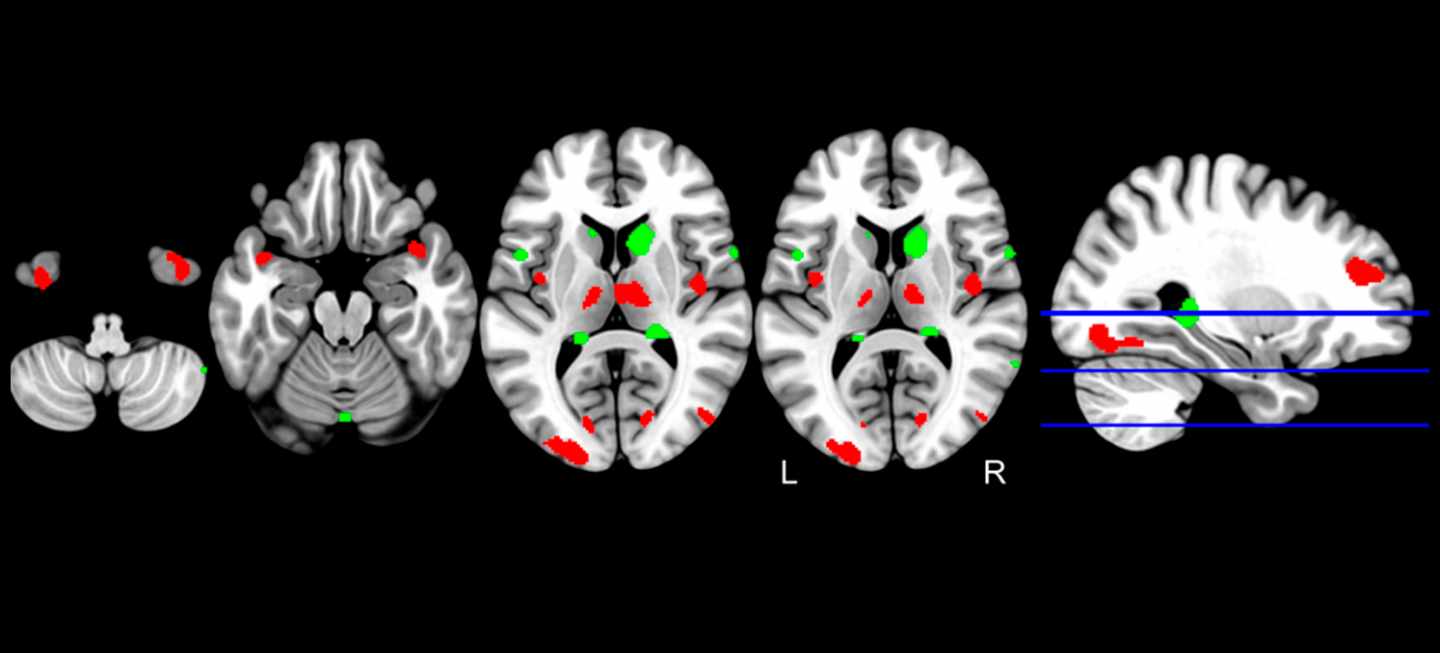 Menor presencia de sustancia gris en el hipocampo, relacionada con alzhéimer