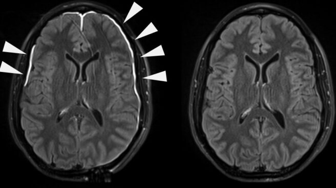 Meninges dañadas tras un golpe y cerebro sanado 35 días después