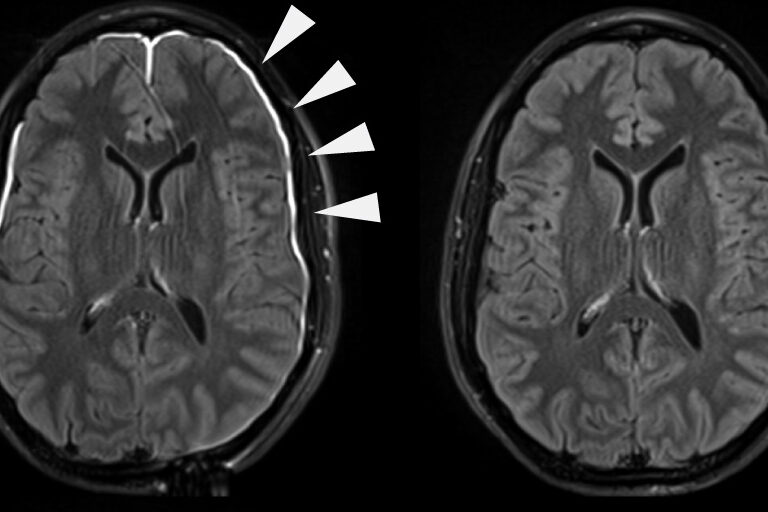 Así se recupera tu cerebro tras un golpe en la cabeza