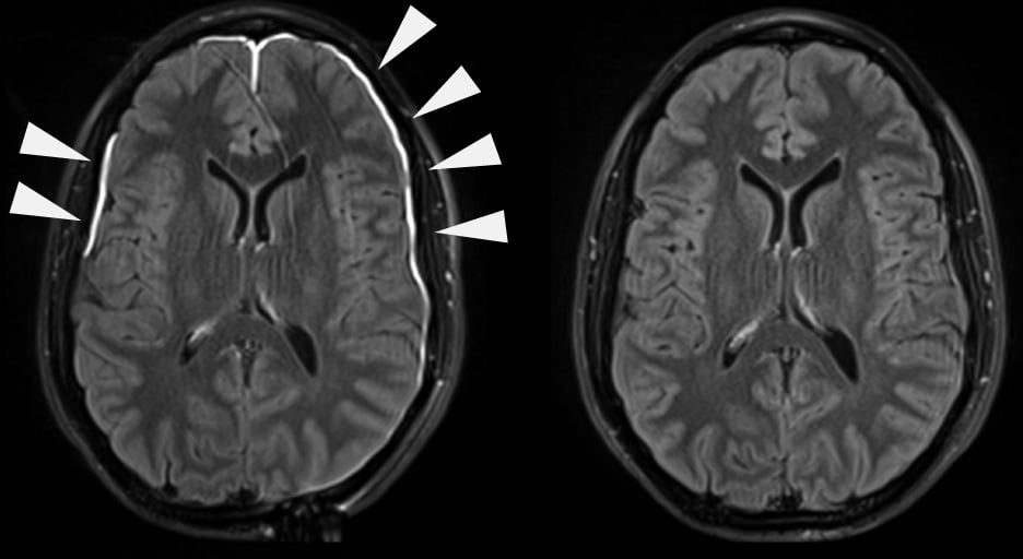 Meninges dañadas tras un golpe y cerebro sanado 35 días después