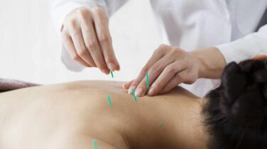 Acupuntura, agujas de placebo
