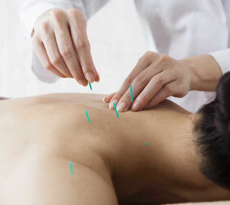 Acupuntura, agujas de placebo