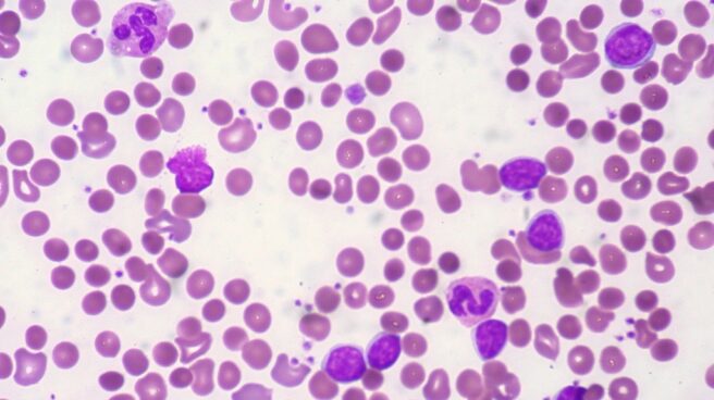 leucemia linfática crónica Leucemia linfática crónica, el más común de los tumores de la sangre.