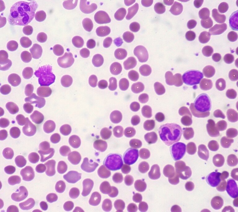 Investigadores constatan el papel de la glucosa en el crecimiento de células tumorales
