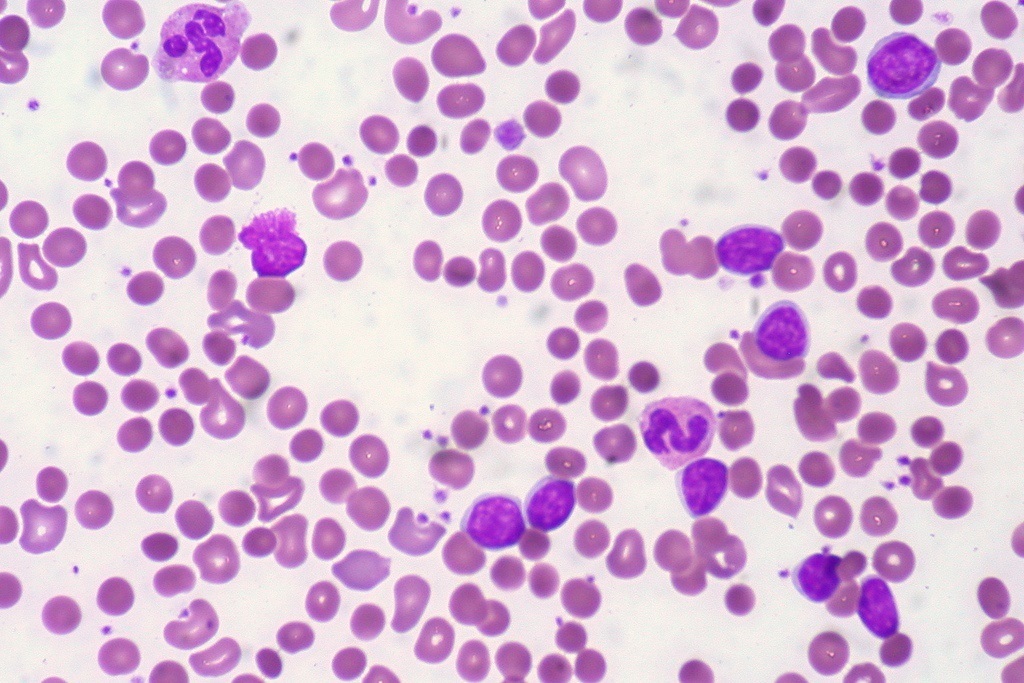 Leucemia linfática crónica, el más común de los tumores de la sangre.