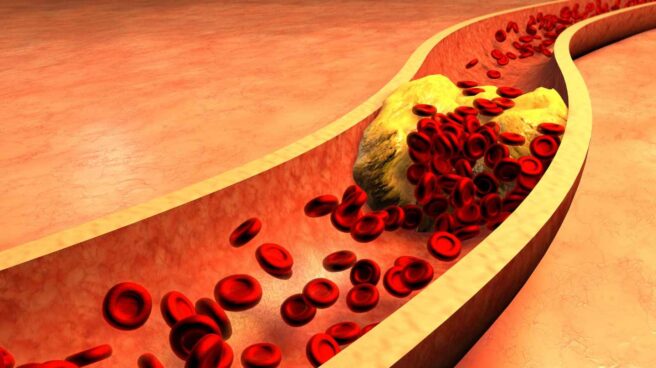 Representación de cúmulos de colesterol en arterias