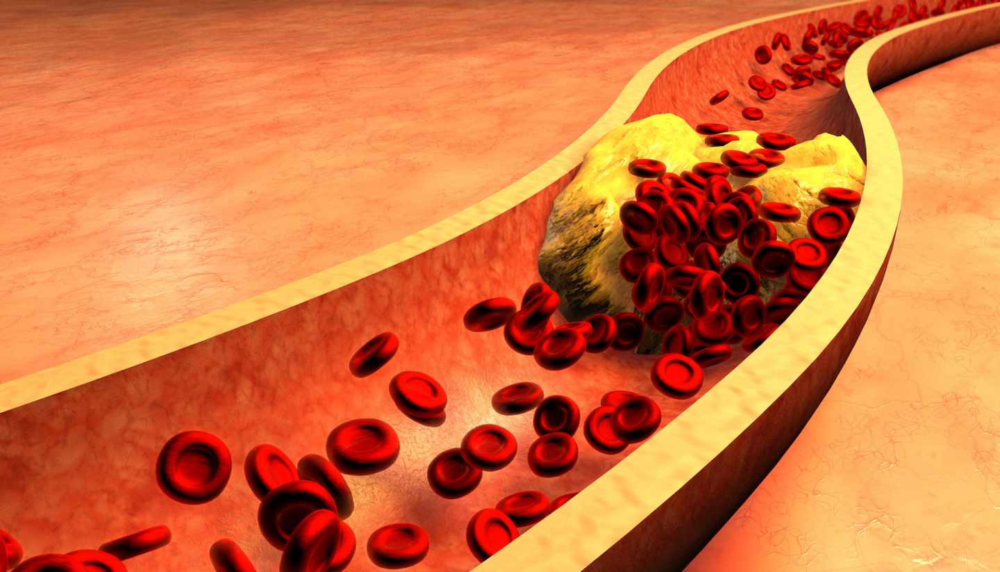 Representación de cúmulos de colesterol en arterias