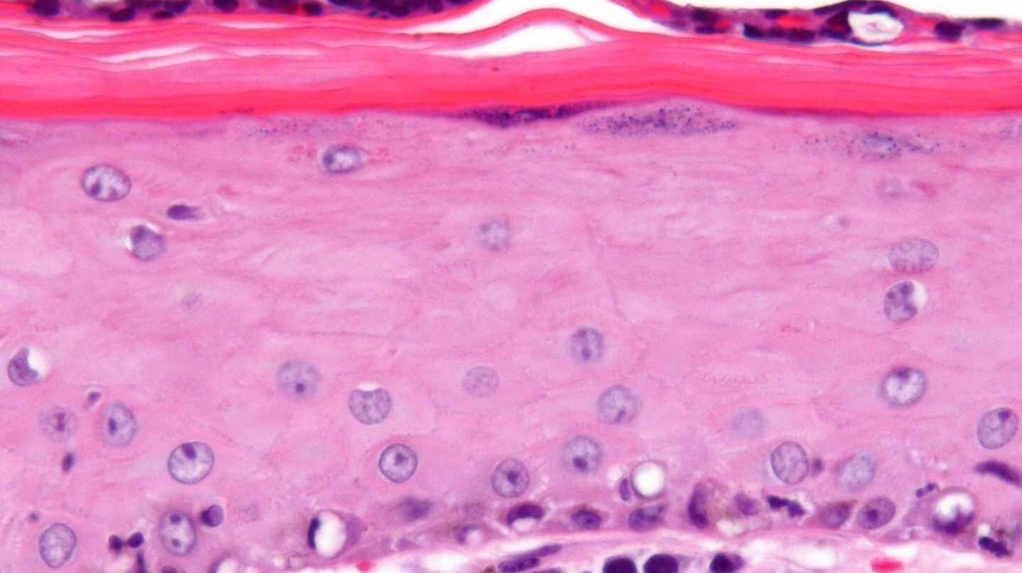 Carcinoma de células de Merkel