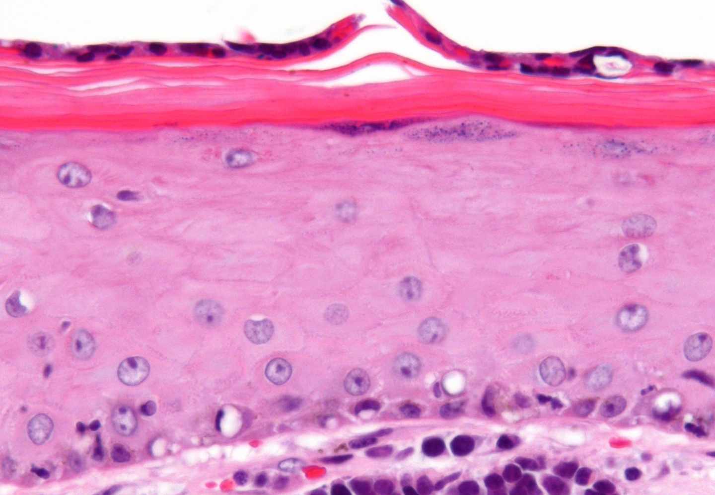 Carcinoma de células de Merkel