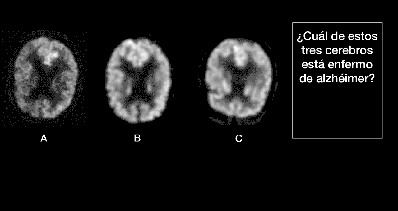 La IA es capaz de distinguir entre varias imágenes aquella de quien desarrollará alzhéimer a partir de ligerísimas diferencias.