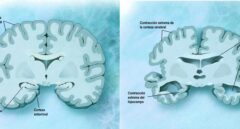 Descubiertos dos nuevos biomarcadores para el diagnóstico precoz del alzheimer