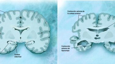 Lilly asegura que donanemab, su terapia contra el Alzheimer,  ralentiza el deterioro de los enfermos