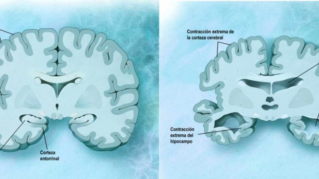Diferencias de un cerebro sano y con alzhéimer