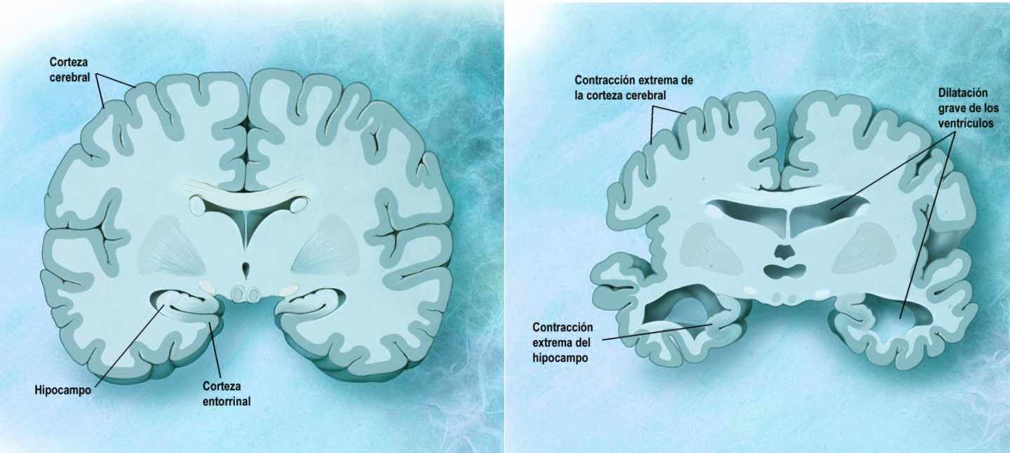 Diferencias de un cerebro sano y con alzhéimer