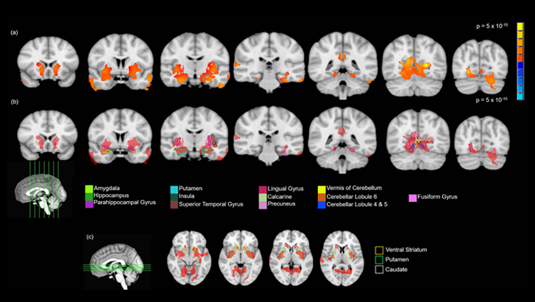 Cambios (en naranja) en el cerebro adolescente al consumir marihuana