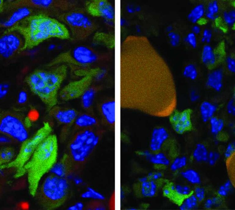 Convertir una célula cancerosa en grasa es posible para evitar la metástasis