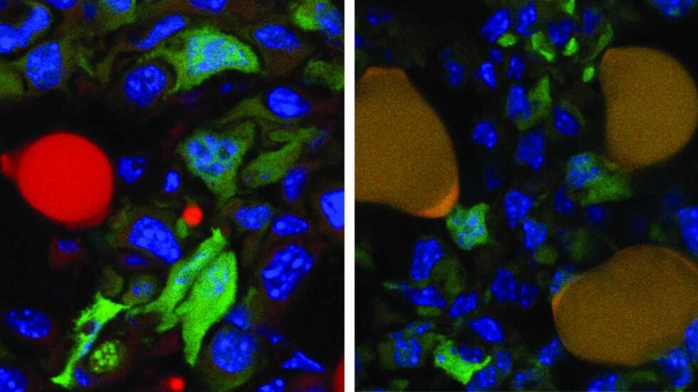 Células de cáncer (verde) convertidas en grasa (naranja)