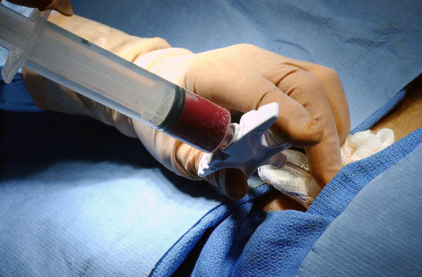 Biopsia y trasplante de médula