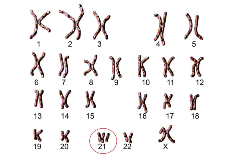 Trisomía en el cromosoma 21, propia del síndrome de Down
