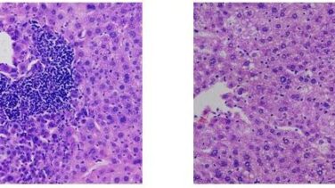 Descubren por qué el cáncer de hígado afecta más a hombres que a mujeres