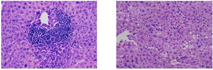 Descubren por qué el cáncer de hígado afecta más a hombres que a mujeres