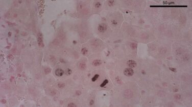 El CNIC encuentra un posible tratamiento para el cáncer de hígado