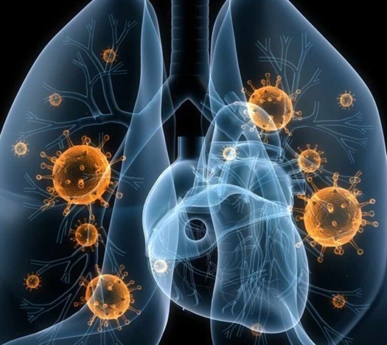 Una nueva estrategia española contra el cáncer de pulmón multiplica por seis las tasas de curación