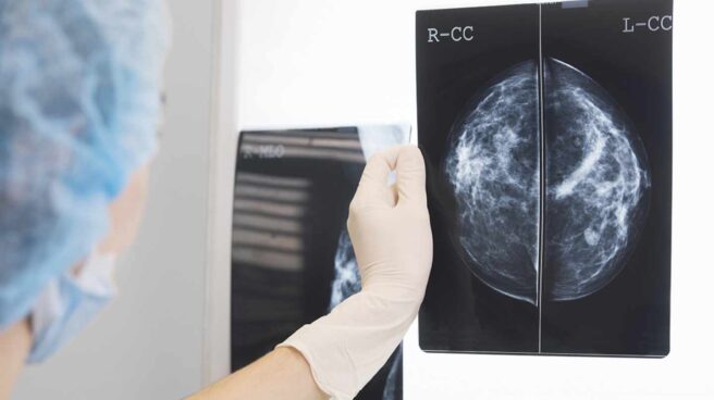 Radiografía de mama Radiografía para analizar un cáncer de mama