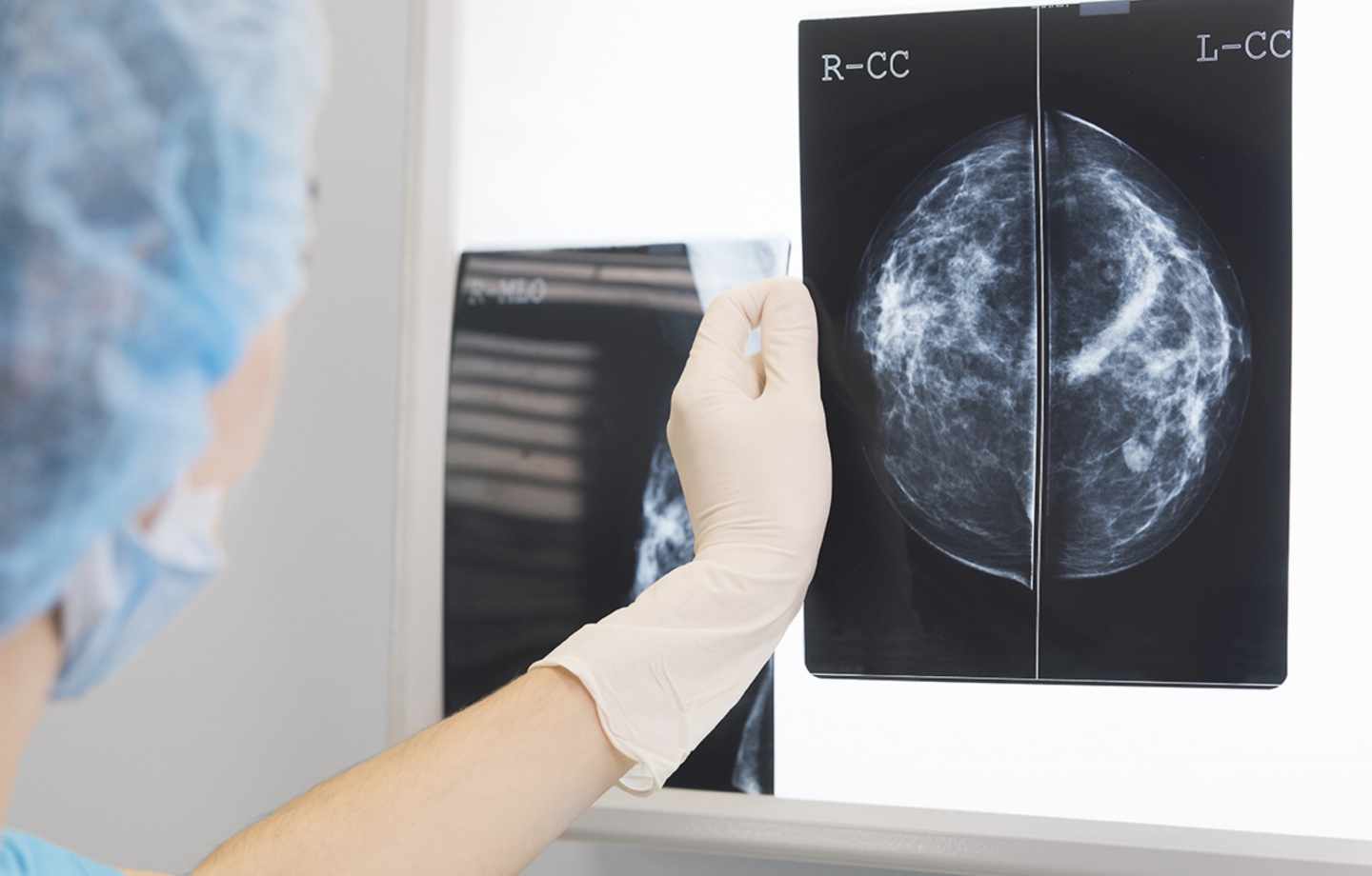 Radiografía para analizar un cáncer de mama