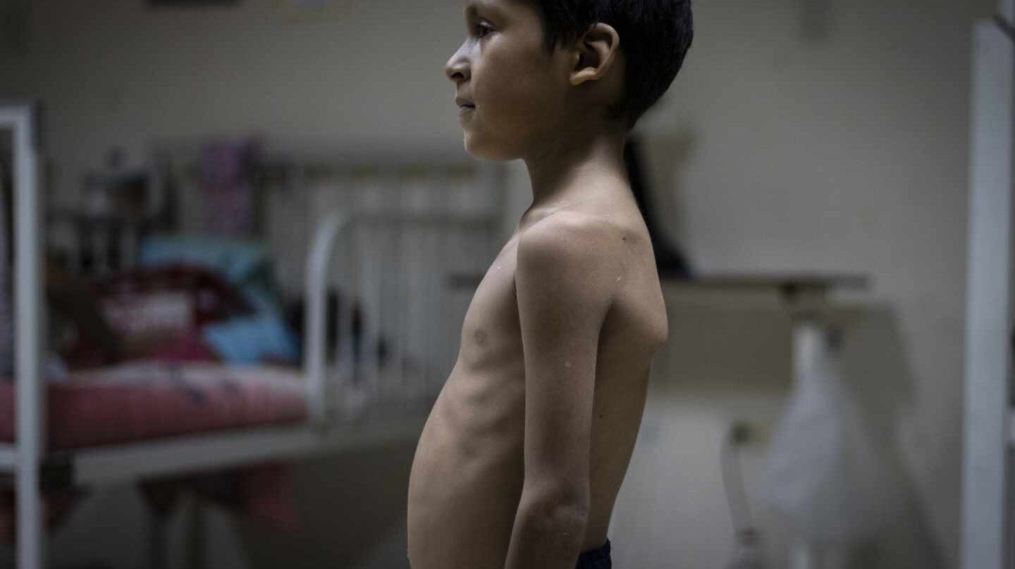 Juan Luis, de cinco años, pesa 14 kg y proviene del Delta Amacuro.