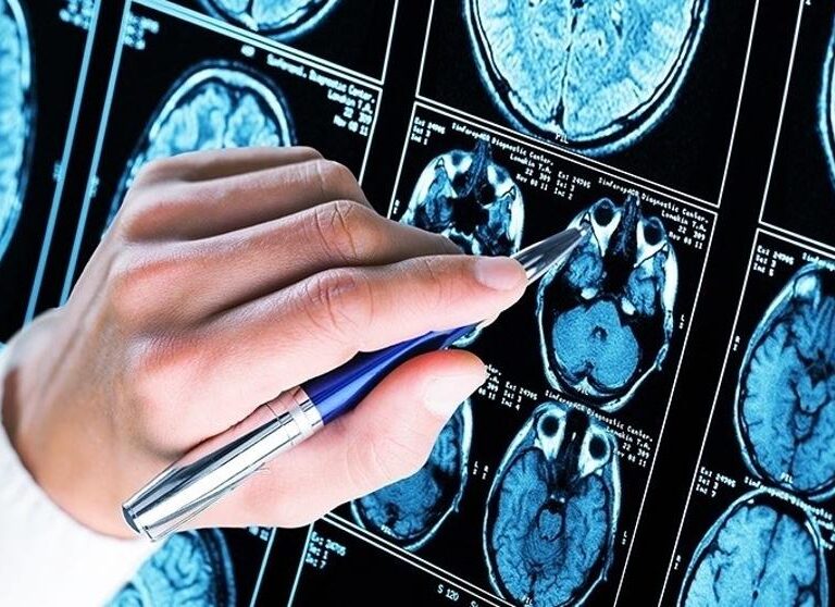 Pfizer ocultó que uno de sus fármacos para la artritis podía prevenir el alzheimer